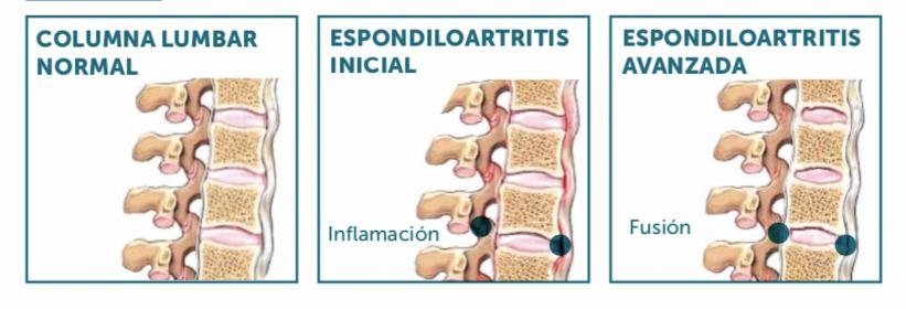 espondiloartritis